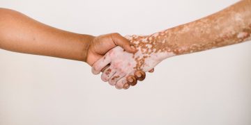 Enfin une solution remboursée pour les personnes atteintes de vitiligo