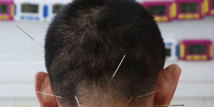 Les acupuncteurs répliquent avec véhémence aux critiques de Vandenbroucke sur leur pratique – RTBF Actus